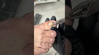 Most Twisted Ingrown Nail I’ve Seen!