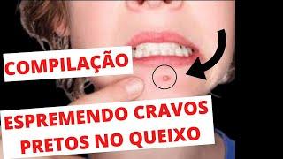ESPREMENDO CRAVOS do Queixo-Compilação Removendo CRAVOS Gigantes Espinhas
