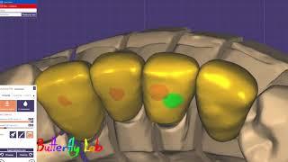 Как сделать имакс коронки в exocad. How to make emax crowns in exocad.