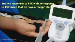 4-Neuromuscular monitoring, TOF & PTC during surgery