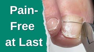Walks Pain-Free Again: Twisted Toenail Fixed