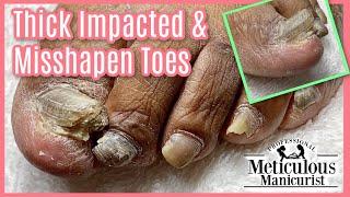 A PEDICURE For TOE NAIL FUNGUS TRANSFORMATION - PART 2