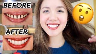 Composite VS Porcelain Veneers (procedure, cost, experience, advantages & disadvan | Lovely Geniston