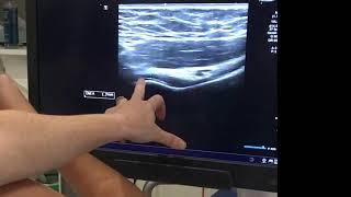 IGHL adhesive capsulitis ultrasound