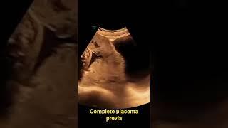 placenta previa##learning #ultrasound #medicalimaging