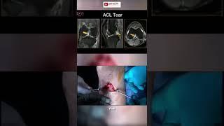 Combined ACL-R and ALL-R Covering all Bases - Dr. Camilo Helito