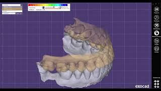 Секреты Exocad - выравнивание сканов