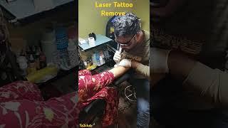 Tattoo Remove| Laser Treatment| Parmanent Tattoo Remove| Hide your Tattoo| Vanish Tattoo#tattoo #ink