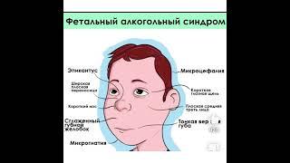 Медицина: Фетальный алкогольный синдром/11.02.22