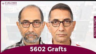 Hair Transplant Journey: From Grade 6 Baldness to Full Hair with Eugenix (Before & After)