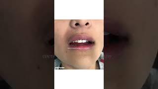 Gum lift | laser gum contouring | Dr. Yazdan | laser gum treatment | gum contouring laser #dentist