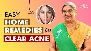 Clear Acne at home | Acne Removal Skincare | Quick Pimple removal remedies