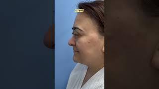 Ринопластика с поднятием спинки носа