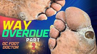 Way Overdue, Part 2: Callus With A Hidden Surprise