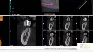 Planning Dental Implant Placement