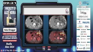 Peritoneal Metastasis: PET/CT The Keen Observer