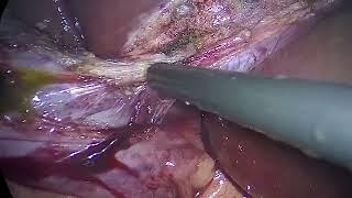 Laparoscopic Cholecystectomy 24