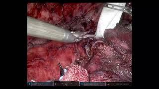 Cerfolio Robotic - Technical Highlights,  Robotic Sleeve LUL with Anastomosis Between LMSB and LLL