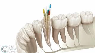 Endodoncia - Liečba koreňových kanálikov | City Dental Clinic Bratislava