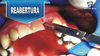 CIRURGIA DE REABERTURA E INSTALAÇÃO DE CICATRIZADOR