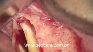 Piezo Endodontic Microsurgery