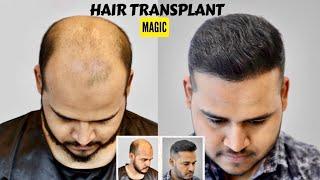 Power of Hair Transplant | Unbelievable Hair Transplant Result |A Complete Hair Transplant Procedure