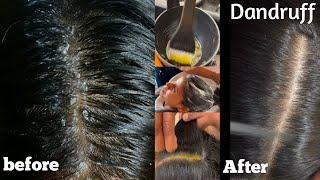 Dandruff Treatment Instant Result 100% Work || Dandruff Treatment Tutorial|| Salonfact