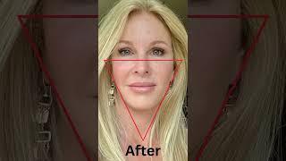 Dr. Amir Karam's Vertical Restore Facelift is the KEY to a YOUTHFUL APPEARANCE!