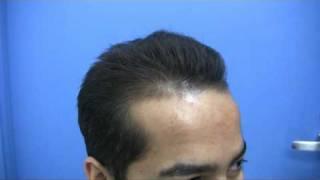 Hair Transplant by Dr Jerry Wong - 3446 Grafts - 1 Session.
