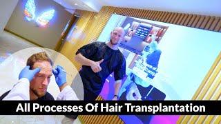 All Processes Of Hair Transplantation