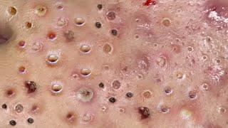Loan Nguyen Acne Treatment 7p