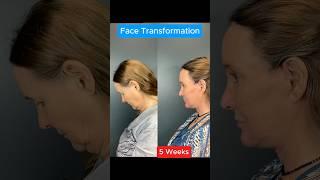 Amazing 5 Week Facelift Transformation #facelift