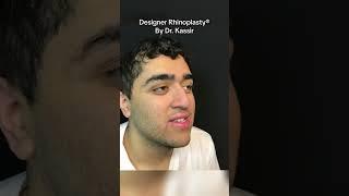 Male nose job #malerhinoplasty #malenosejob #nosejobbeforeandafter #nosejobrecovery #nycnosejob