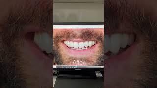COMPOSITE BONDING AT BOND DENTAL LONDON
