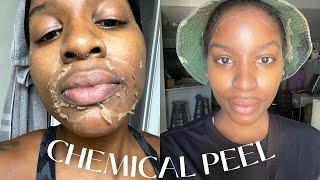 CHEMICAL PEEL | 1st time experience | Full Process | Peeling + Aftercare