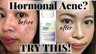 DIM SUPPLEMENT FOR HORMONAL ACNE | EFFECTIVE TALAGA!