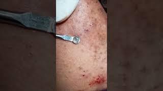 Pimple popping || #whatilearntoday || acne