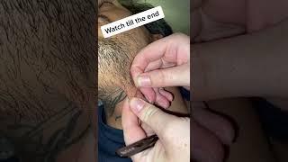 Blackheads & milia , big cystic acne blackheads extraction whiteheads removal pimple popping. #270