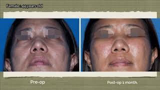 Mid-Face Lift(Cheek Lift) By Phibeauty Clinic