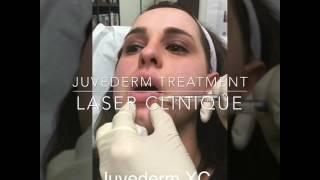 Lip Augmentation by P. Alexander Ataii, M.D. at Laser Clinique