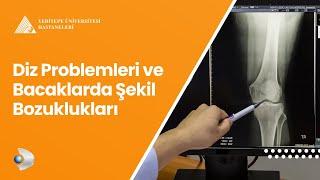 Diz Problemleri ve Bacaklarda Şekil Bozuklukları | Op. Dr. Ömer Yonga