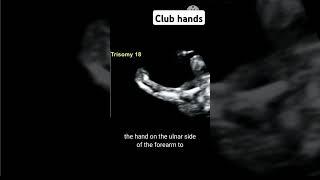 Club hands #radiology #pregnant #ultrasound #babyultrasound #baby #pregnancyscan