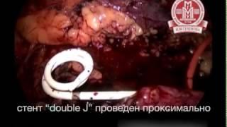 Лапароскопическая уретероуретеростомия и уретеролитоэкстракция