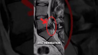 Does size matter… when it comes to disc herniations?