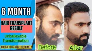 6 Month Hair Transplant Result | Day by day Hair Growth | Part 2