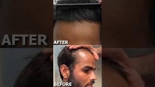 The Shocking Transformation of a Hair Transplant | Awish clinic | #viral #hairtransplant #haircare