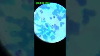 peripheral smear Gemsa staining.