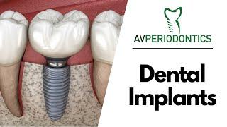 Dental Implants - Manhattan, NY - Dr. Alexander Volchonok