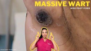 Massive Warts: Causes, Symptoms, and Treatment Options ||  Miss Foot Fixer