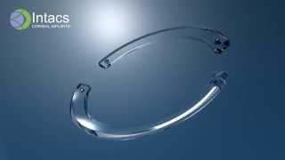 INTACS Corneal Implants